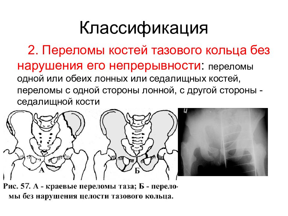 Переломы таза травматология презентация