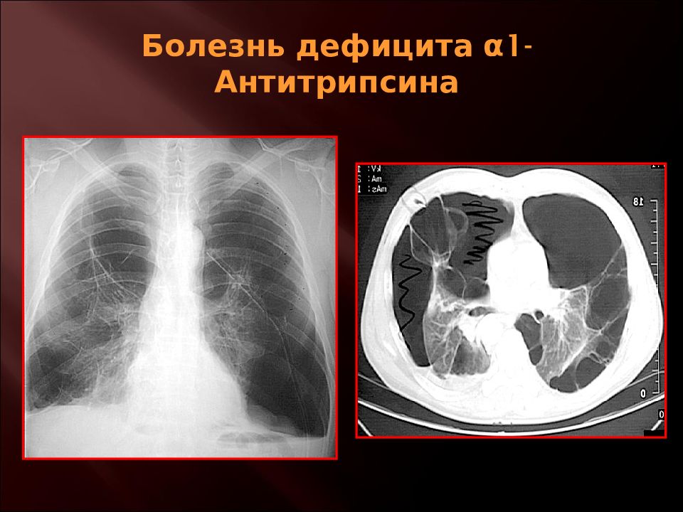 Заболевание аномалия. Кт при дефиците альфа1 антитрипсина. Недостаточность антитрипсина Альфа 1 кт. Дефицит Альфа 1 антитрипсина рентген. Дефицит альфа1-антитрипсина педиатрия.