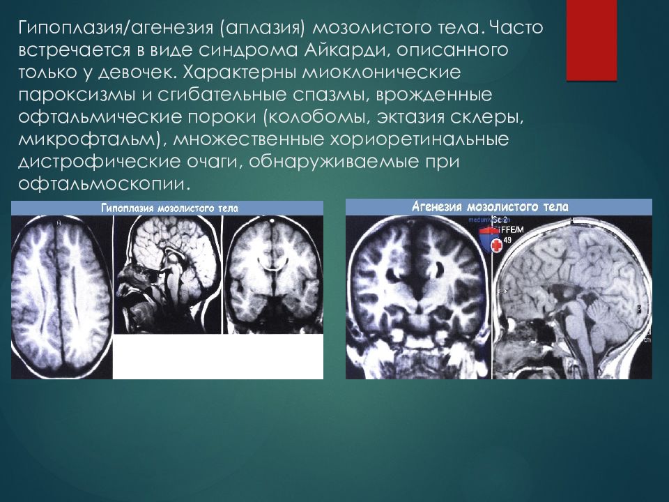 Гипоплазия правой головного мозга. Агенезия мозолистого тела. Гипоплазия/аплазия мозолистого тела. Аплазия (агенезия) и гипоплазия мозолистого тела.