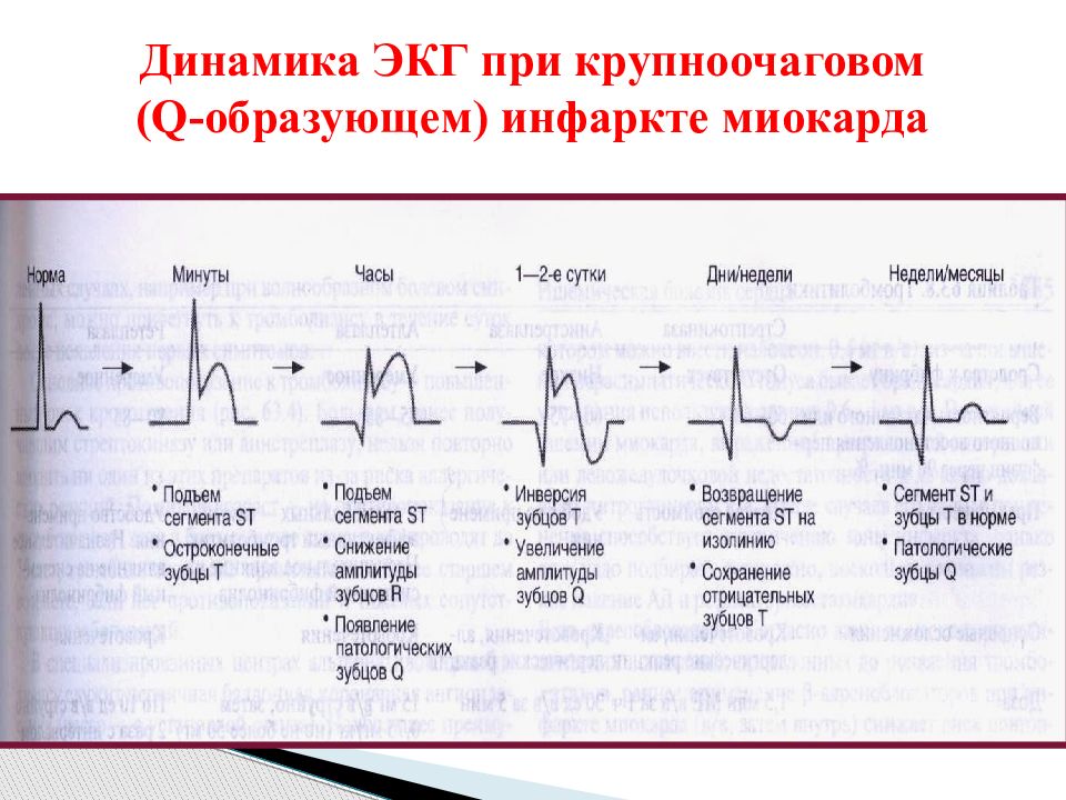 Фото кардиограммы при инфаркте. Острый крупноочаговый инфаркт миокарда на ЭКГ. ЭКГ признаки крупноочагового инфаркта миокарда. Изменения на ЭКГ остром инфаркте миокарда. Динамика ЭКГ при инфаркте миокарда.