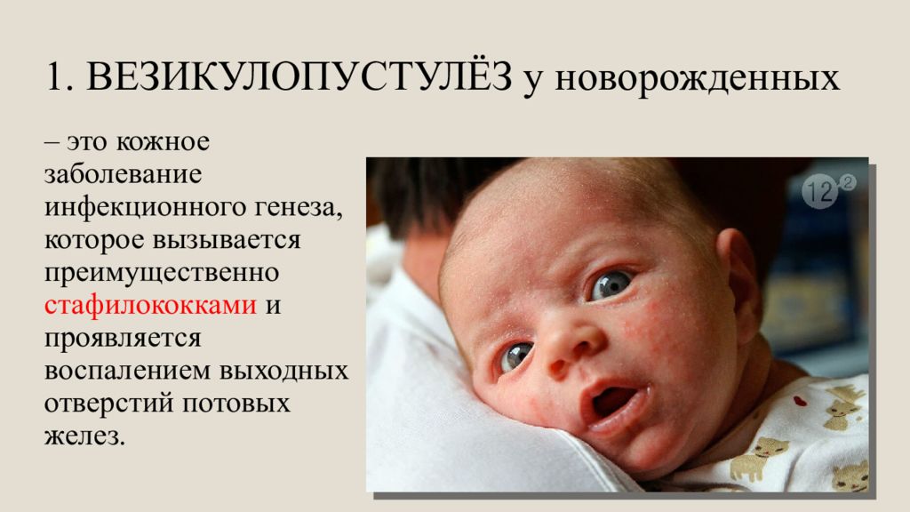 Генерализованное гнойные заболевания новорожденных. Пузырчатка стафилококк. Эпидемическая пузырчатка новорожденных. Везикулопустулез Новорожденные.