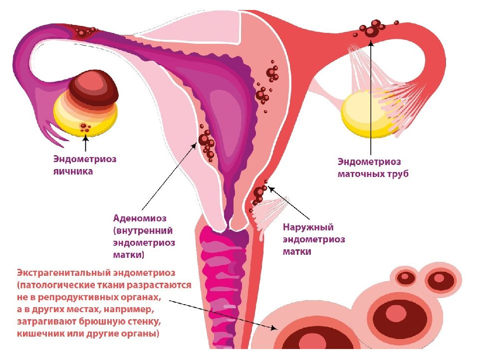 Эндометриоз что это такое картинки