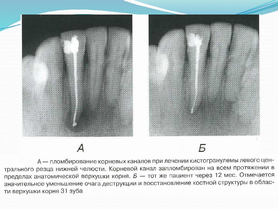 Осложнение лечения периодонтита. Периодонтита 3 канального зуба. Рецидивирующий периодонтит. Периодонтита трехкорневого зуба.