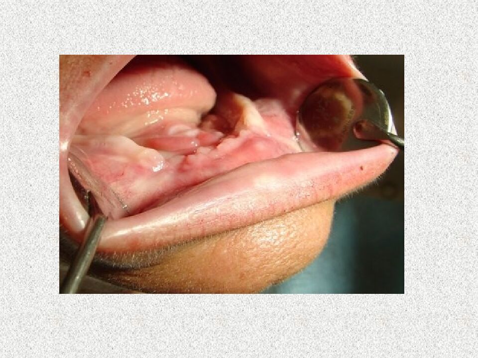 Funksional otisklar uchun individual qoshiqchalar