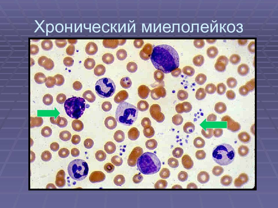 Гемобластозы патологическая анатомия презентация