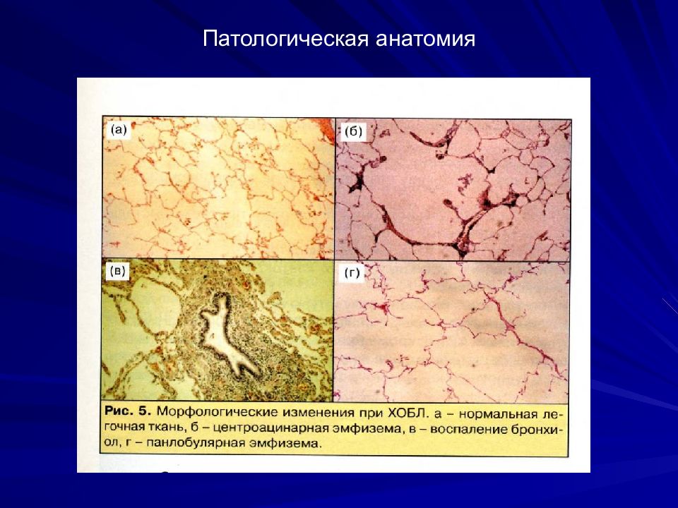 Краткая патологическая анатомия. Хроническая обструктивная болезнь легких патологическая анатомия. ХОБЛ патологическая анатомия.