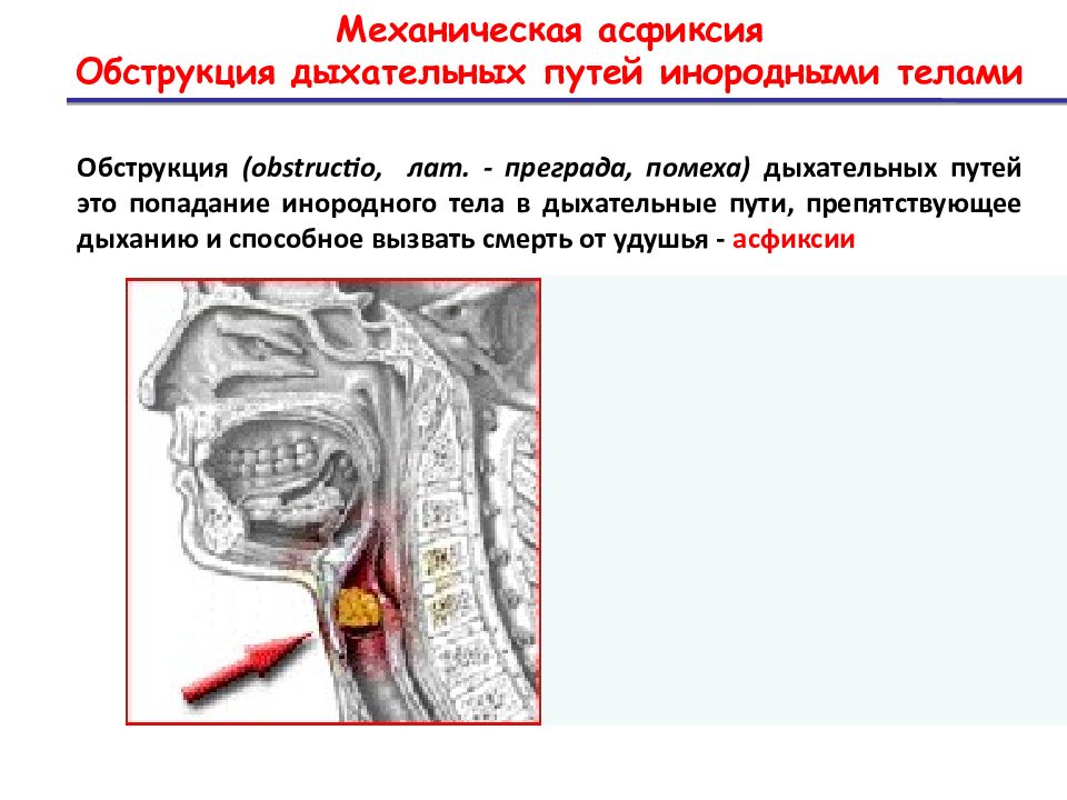 Признаки обструкции дыхательных путей схема полная и частичная может дышать