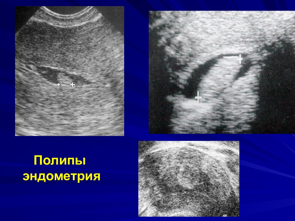 Эндометрий д. Аденоматозные полип эндометрия УЗИ. Макропрепараты полип эндометрия. Фиброзный полип эндометрия.