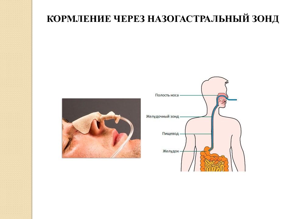 Кормление через зонд