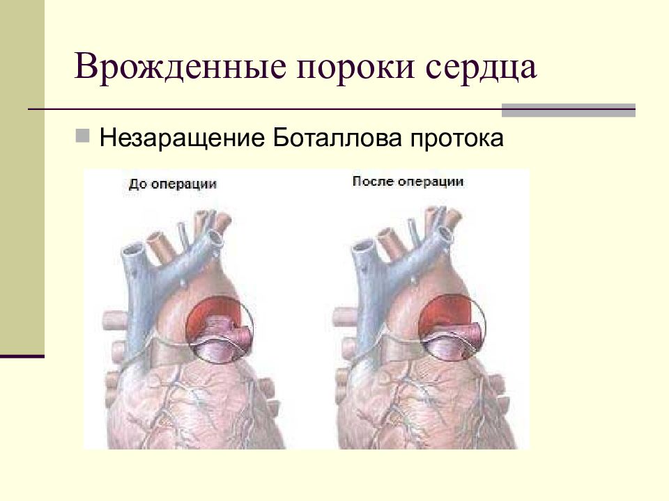 Врожденные и приобретенные пороки сердца презентация