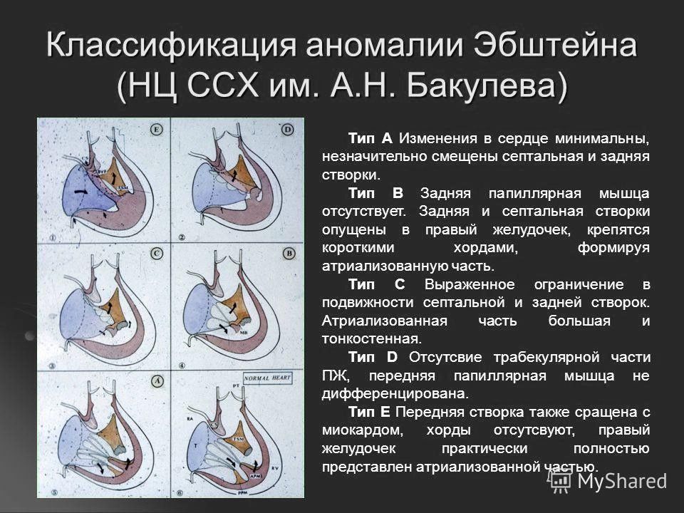 При аномалии эбштейна легочный рисунок