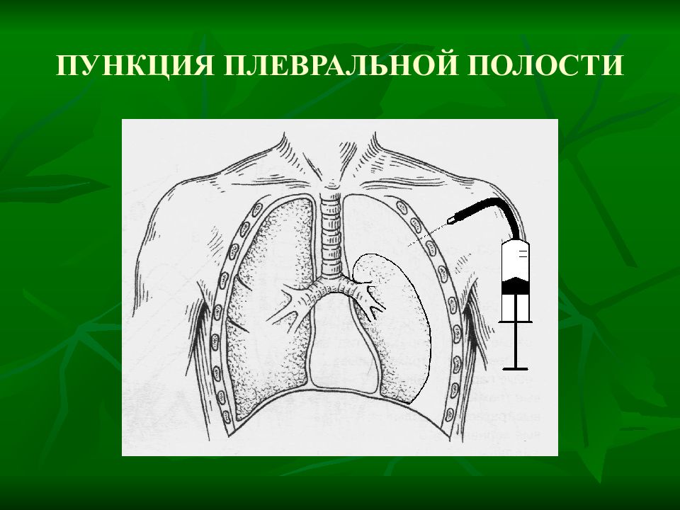 Пункция плевральной полости. Пункция плевральной полости во 2 межреберье. Пункция при пневмотораксе. Пункция плевральной полости при пневмотораксе. Пункция плевры при пневмотораксе.