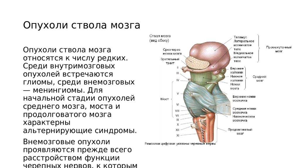 Диффузная опухоль ствола головного мозга.