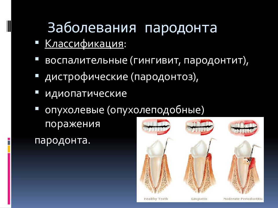 Идиопатические заболевания пародонта презентация