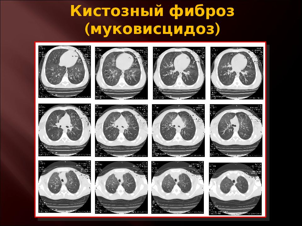 Кистозный фиброз. Муковисцидоз легких кт. Кт признаки муковисцидоза.