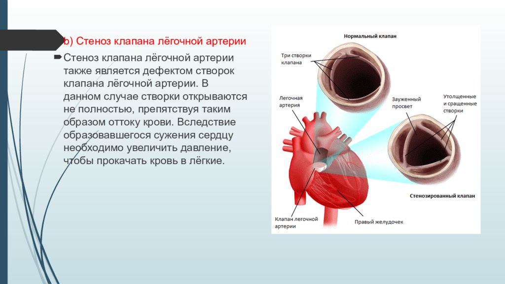 Стеноз это. Клапан легочной артерии диаметр 20мм. Створки клапана легочной артерии название. Биоклапан легочной артерии. Створки клапана легочного ствола.