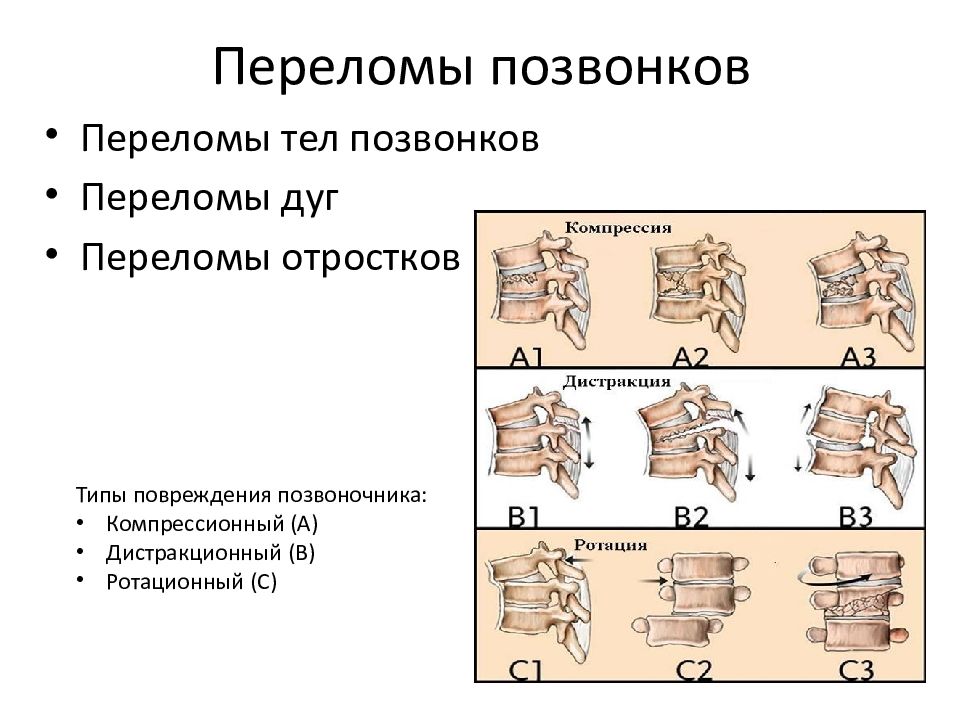 Перелом туловища