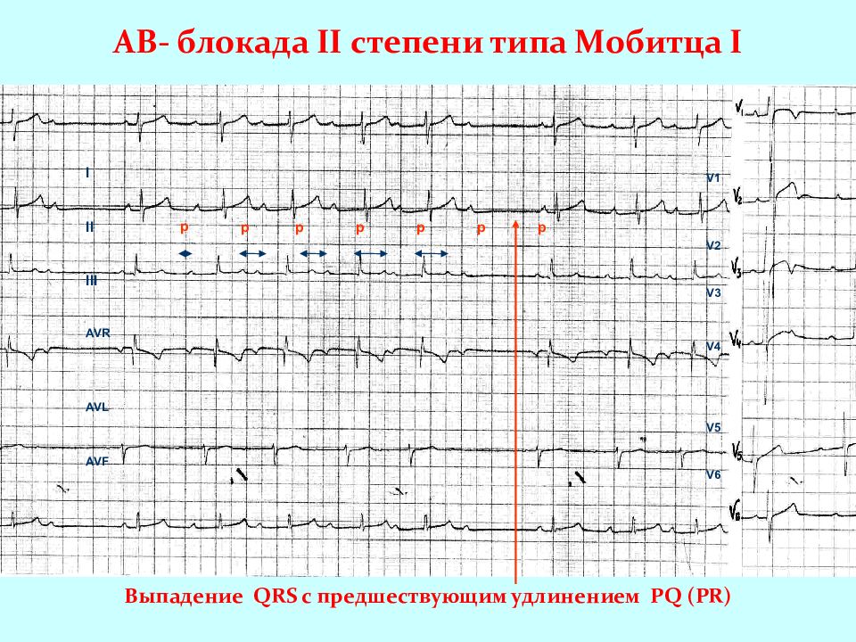 Экг при нарушениях ритма и проводимости презентация