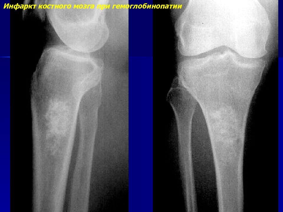 Костные нарушения. Остеома коленного сустава рентген. Остеопороз рентген снимок большеберцовой кости. Локальный остеосклероз бедренной кости. Остеосклероз бедренной рентген.