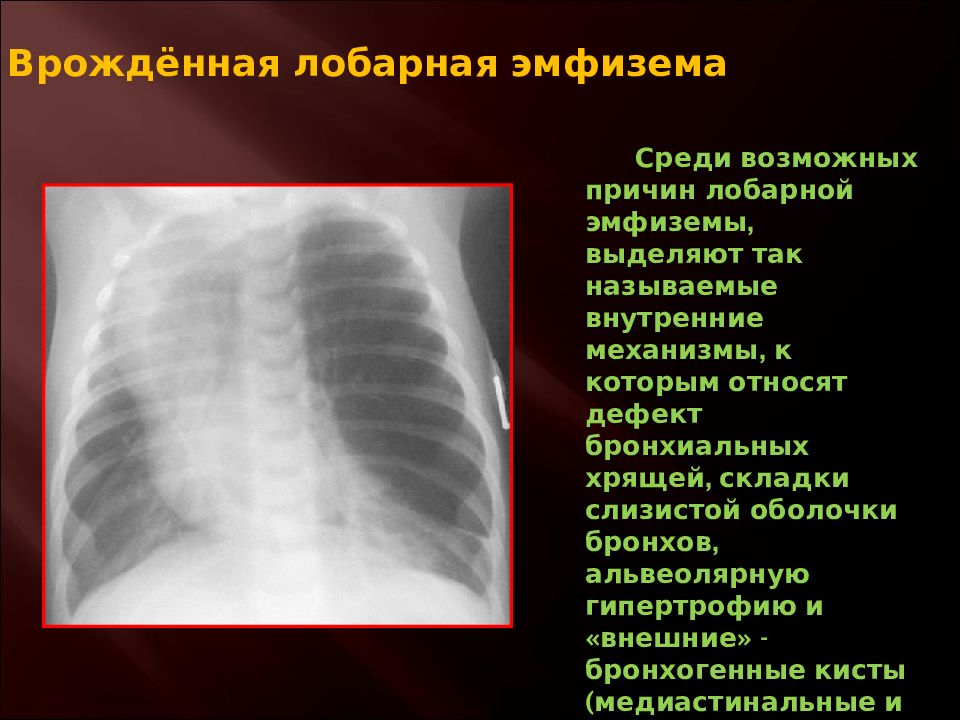 Врожденные пороки развития дыхательной системы презентация