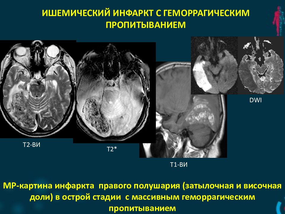 Мр картина латеровентрикулоасимметрии d s