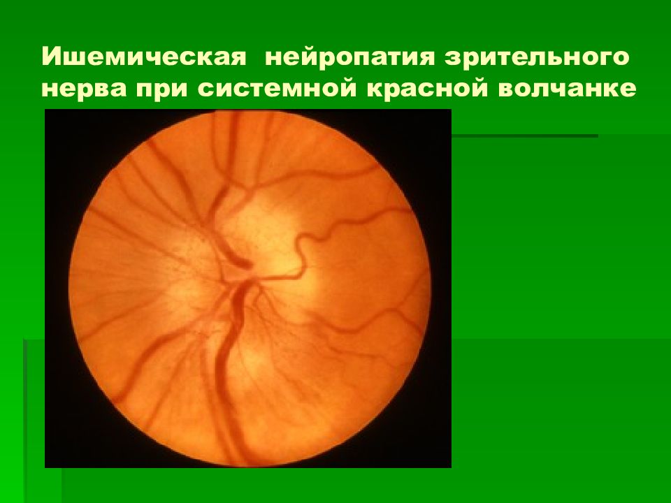 Нейропатия глаза. Ишемические нейропатии зрительного нерва. Ишемическая нейрооптикопатия глаза. Задняя ишемическая нейропатия зрительного нерва. Ишемическая нейропатия зрительного нерва.