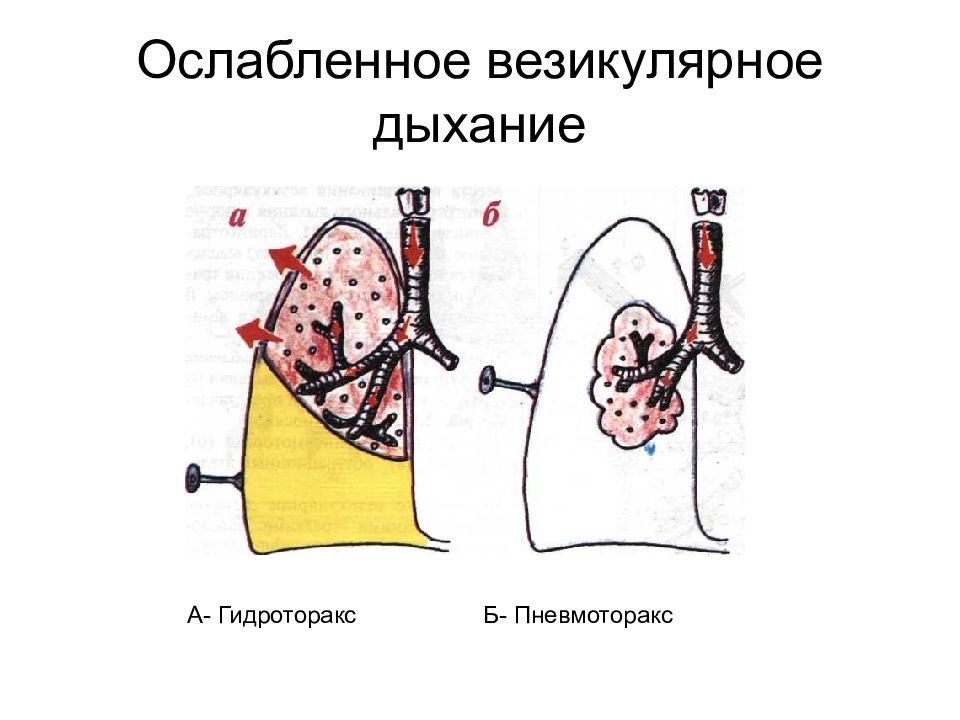 Гидроторакс карта смп