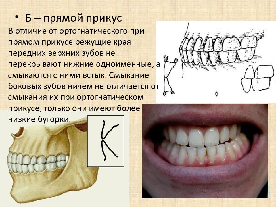Зубы при закрытом рте. Прогенический прикус аномалия зубов. Ортогнатический и прямой прикус. Неправильный прикус прямой. Виды прикуса ортогнатический.