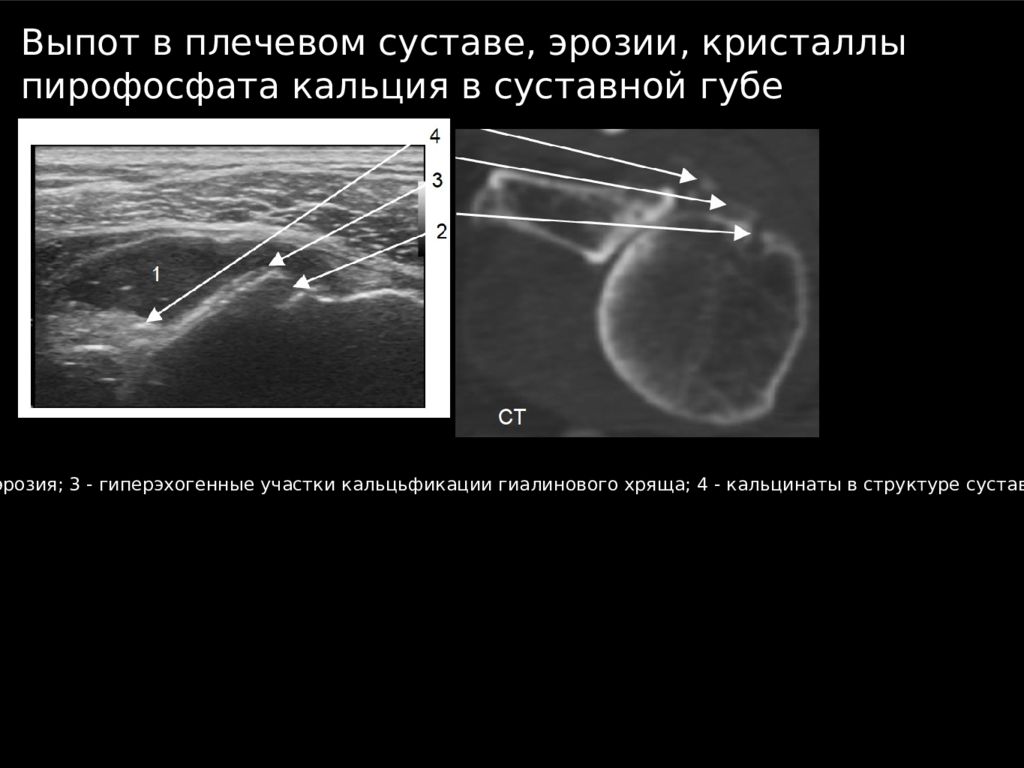 Узи плечевого. УЗИ плечевого сустава книга. Выпот в плечевом суставе по УЗИ. Кальцинат в плечевом суставе.