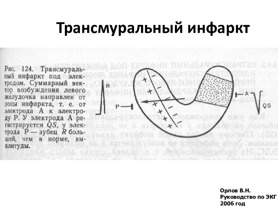 Трансмуральный инфаркт