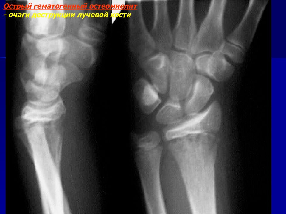 Рентгенодиагностика остеомиелита презентация