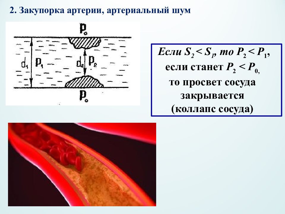 Просвет сосудов. Артериальные шумы. Закупорка просвета сосуда это.