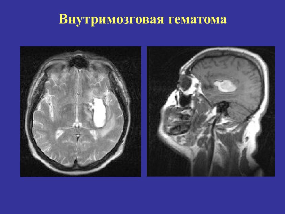 Кт при сотрясении головного мозга