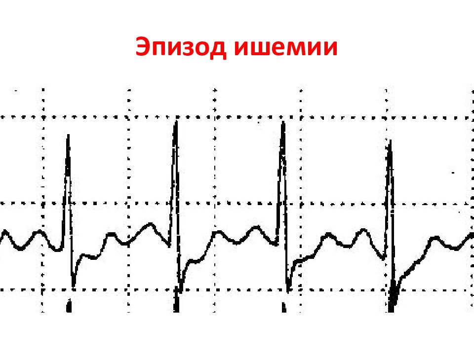 Ишемия боковой стенки на экг