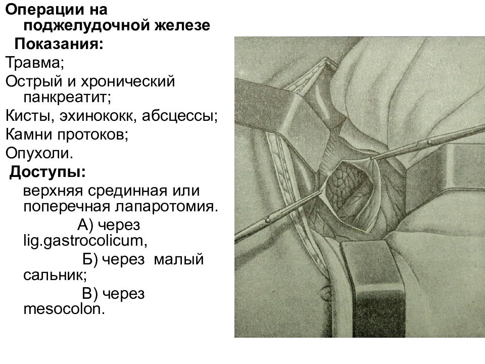 Хронический панкреатит презентация хирургия