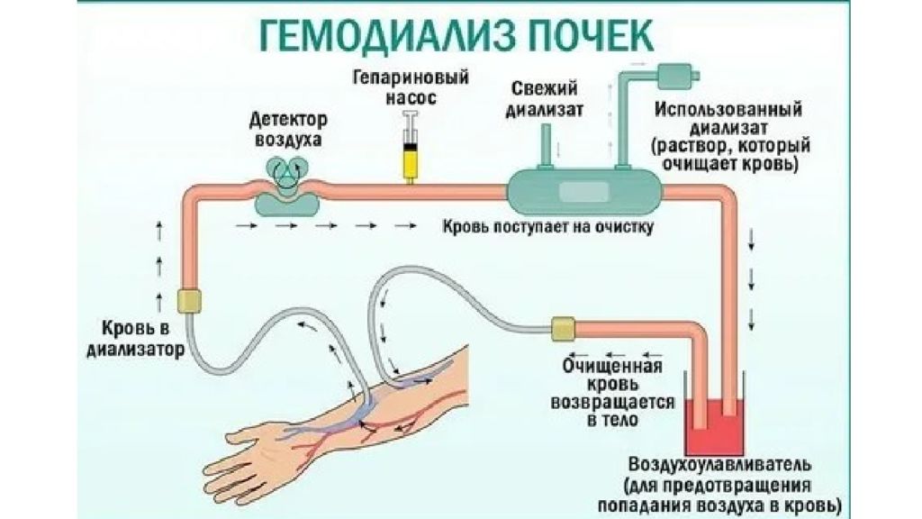 Где происходит очищение крови. Гемодиализ принцип работы. Диализ принцип работы. Схема работы искусственной почки. Принцип работы аппарата для диализа крови.