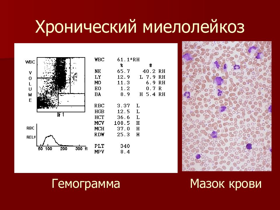 Картина крови при хроническом миелолейкозе