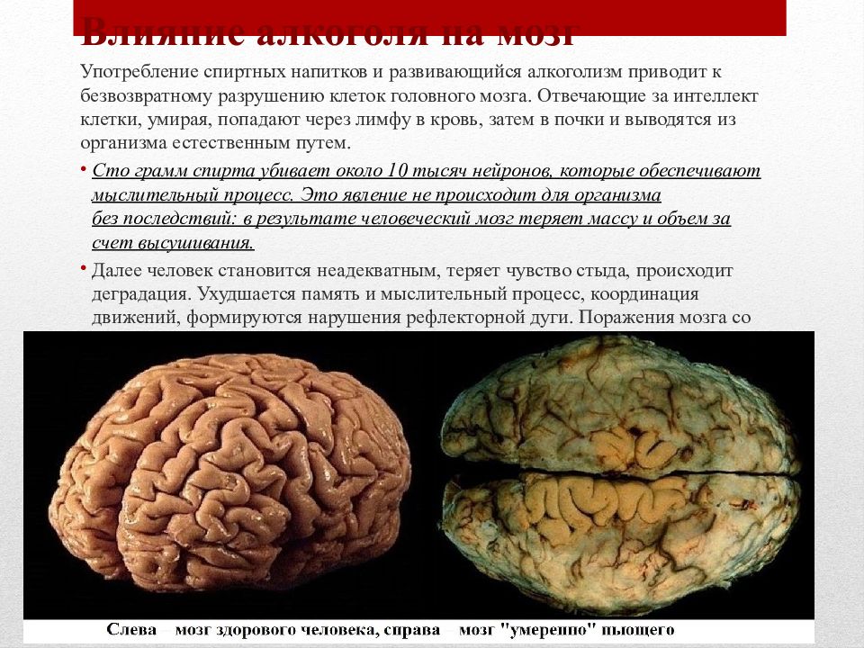 Умершие клетки мозга. Мозг человека алкоголика. Мозг человека и мозг алкоголика.