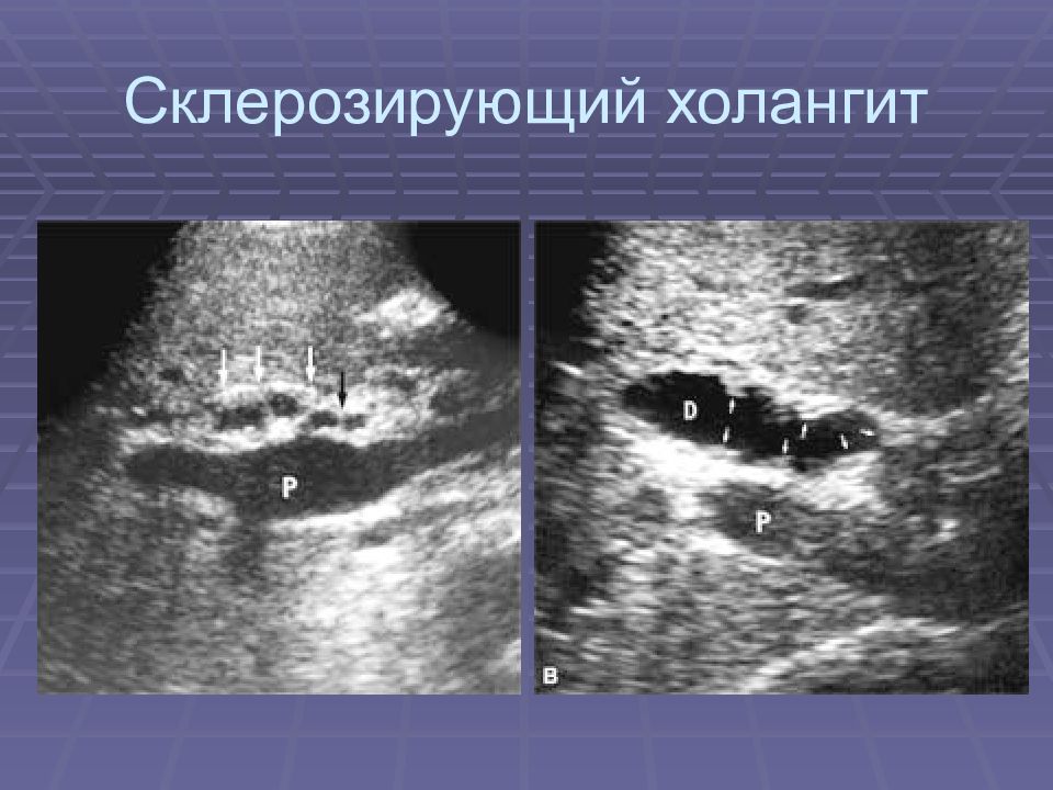 Склерозированный холангит первичный склерозированный. Холангит УЗИ признаки. Склерозированный желчный пузырь мрт. Склерозирующий холангит гистология. Хронический холангит на УЗИ.