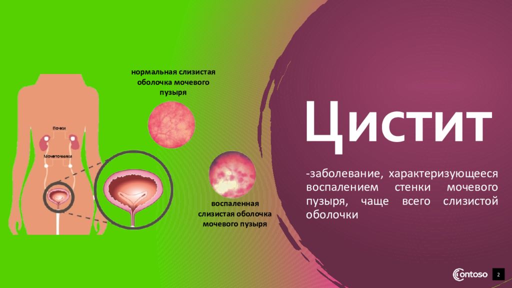 Презентация на тему цистит