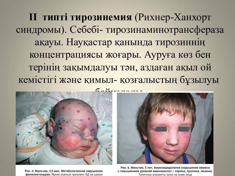 Жеке аминқышқылдардың алмасуы және оның бұзылуының биохимиялық негіздері Жеке аминқышқылдардың алмасуы және оның бұзылуының биохимиялық негіздері
