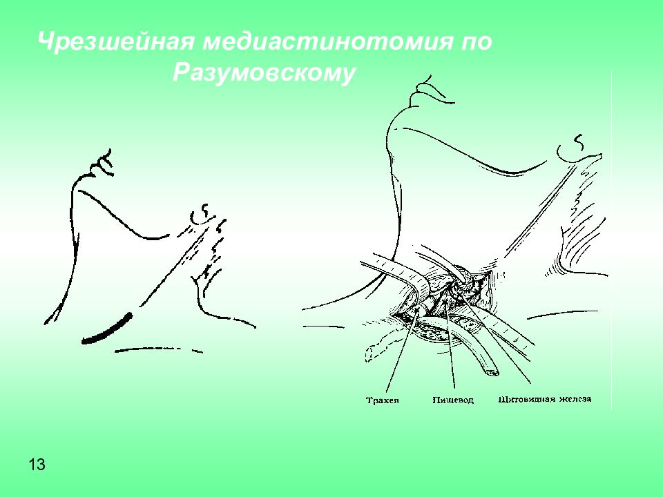 Одонтогенный медиастинит презентация