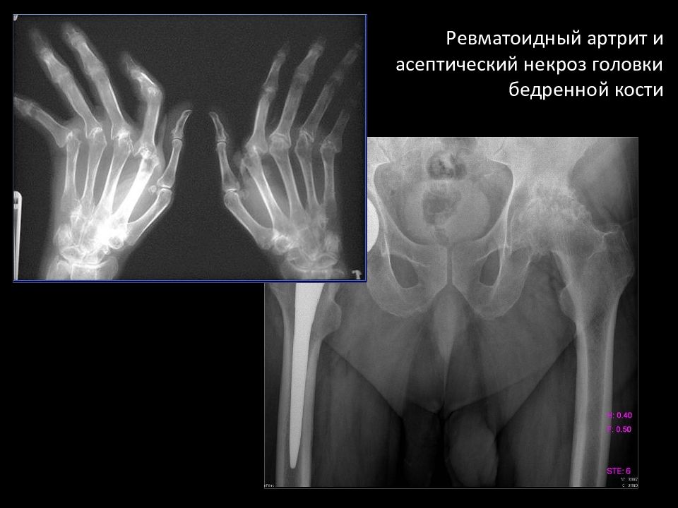 Асептический некроз кости. Остеопороз головки бедренной кости рентген. Асептический некроз лучевой кости. Ревматоидный артрит коксит рентген. Асептический некроз головки пястной кости.