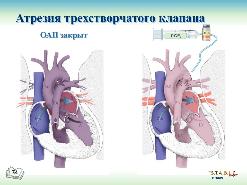 Атрезия трехстворчатого клапана презентация