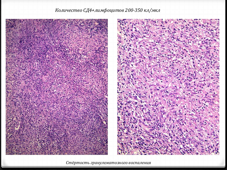 Гранулематозное воспаление презентация