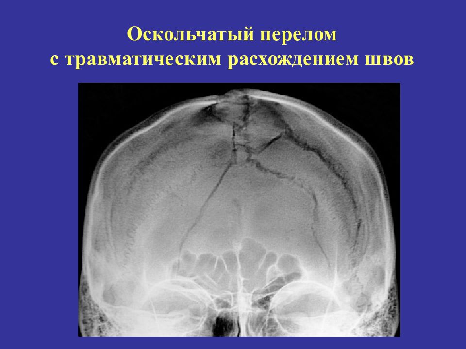 Перелом основания свода. Перелом свода черепа, перелом основания черепа. Оскольчатый перелом лобной кости черепа. Перелом свода черепа рентген.