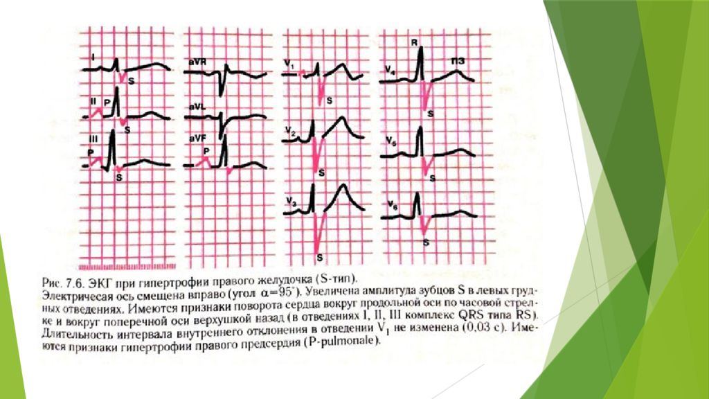Поворот сердца правым желудочком вперед что это. ЭКГ при гипертрофии правого желудочка s Тип. Электрическая ось типа s1-s2-s3. Ось s Тип на ЭКГ. Типы гипертрофии правого желудочка на ЭКГ.