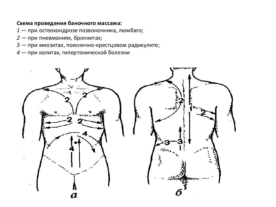 Баночный массаж схемы