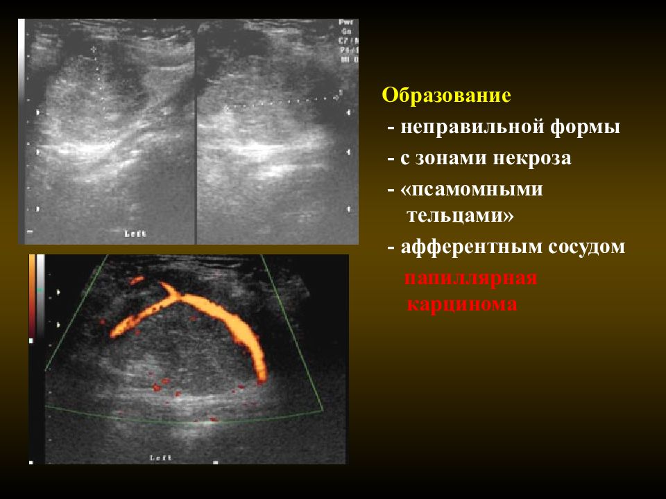 Кистозно-Солидное образование что это. Кистозно-Солидное образование на УЗИ. Солидное образование с кровотоком.