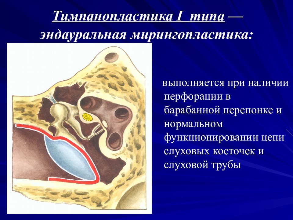 Операция на среднем ухе